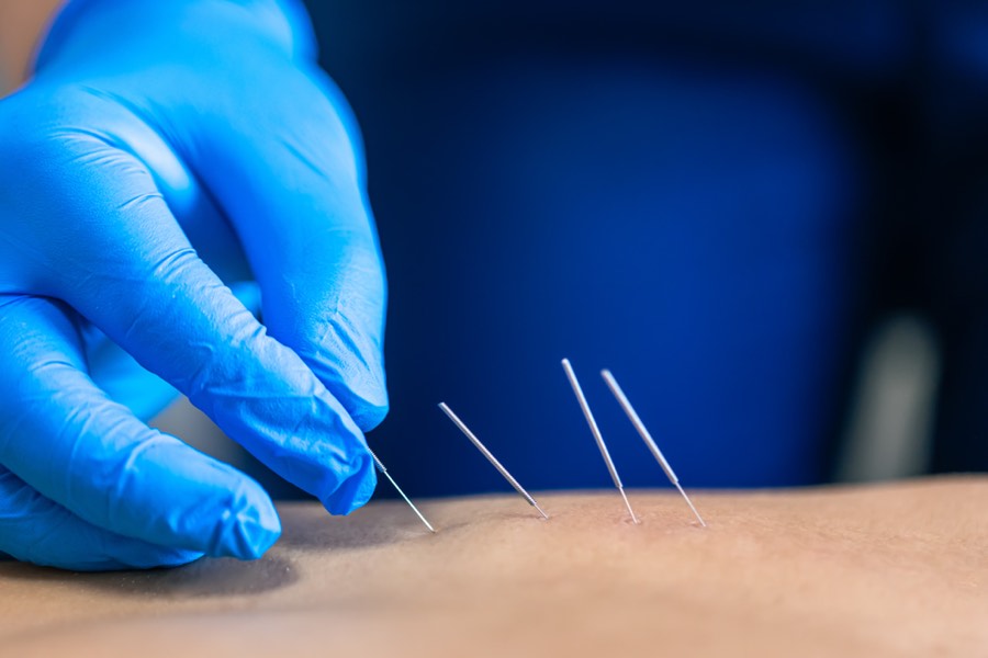 Close-up of dry needling needles being placed